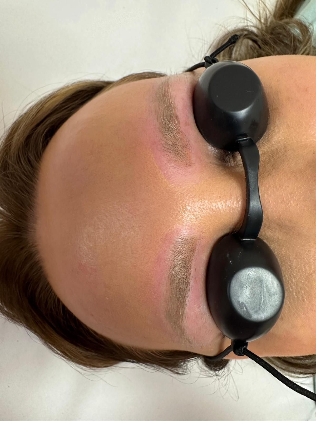 Eliminación de micropigmentación con láser